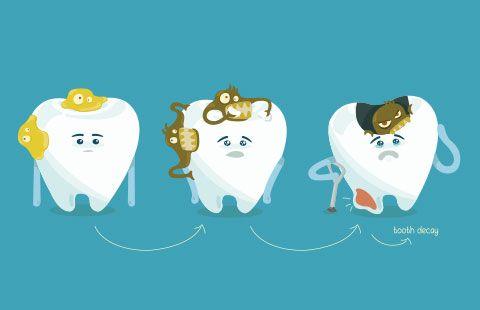 caries dental