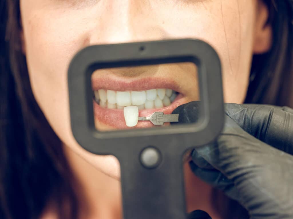 instalación de carillas dentales