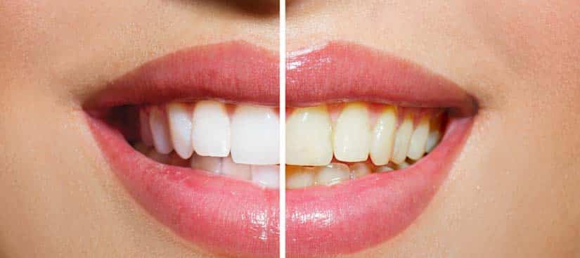 blanqueamiento dental