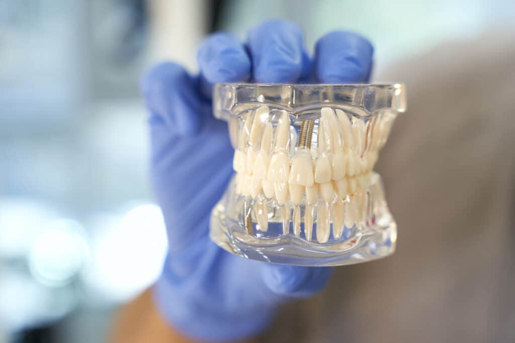 Implante de carga inmediata en una dentadura de plástico