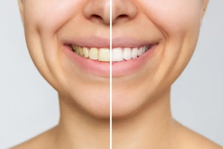 El antes y después de un blanqueamiento de dientes