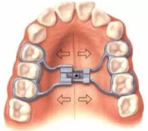 Aparatología de ortodoncia interceptiva