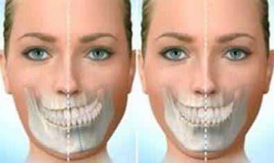 Mujer con asimetría facial