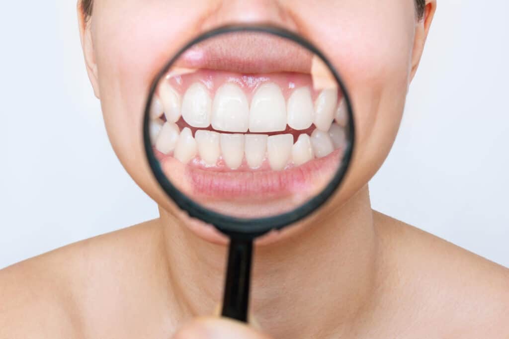 Consejos para que dure más el blanqueamiento dental