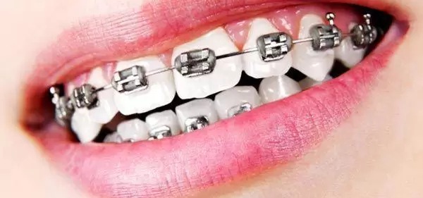 Sonrisa con brackets con acero inoxidable