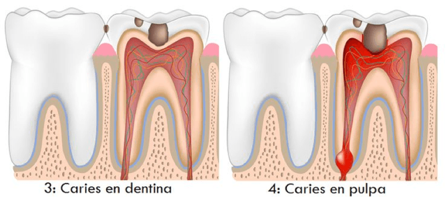 Caries avanzada