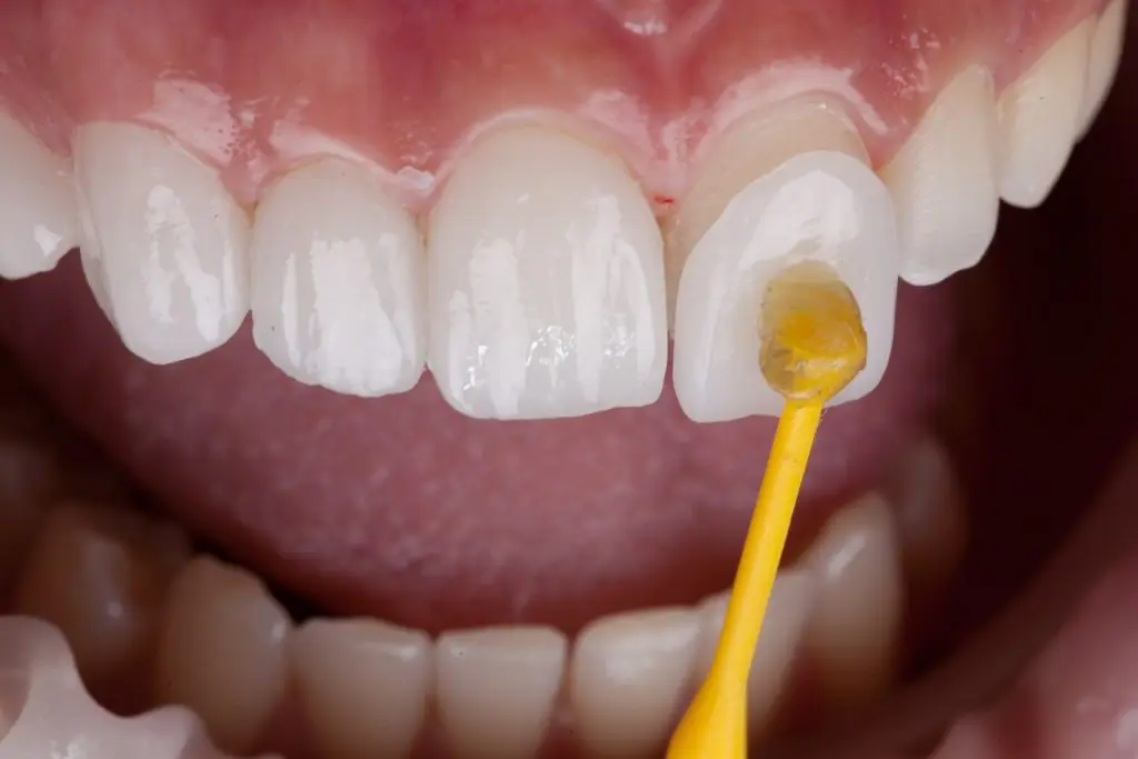 Carillas dentales de porcelana puestas