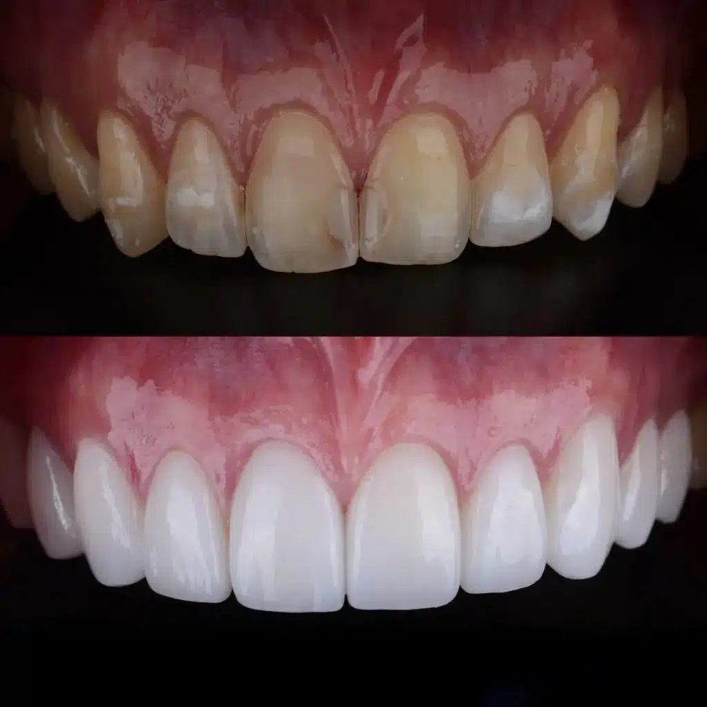 Antes y después de poner carillas dentales composite