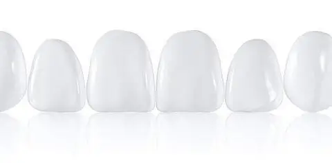Carillas dentales