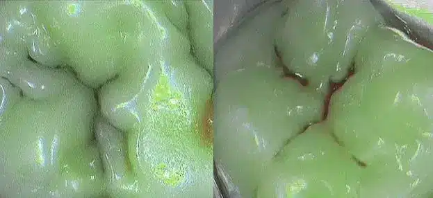 Caries y fisuras detectadas con tecnología vanguardista