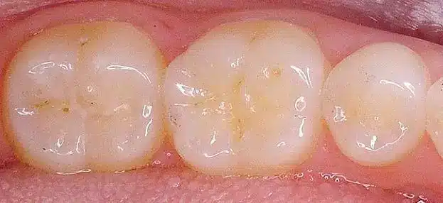 Detección de caries con tecnología vanguardista