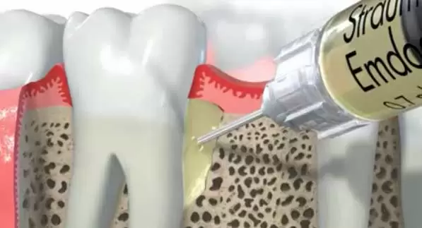 Emdogain Straumann