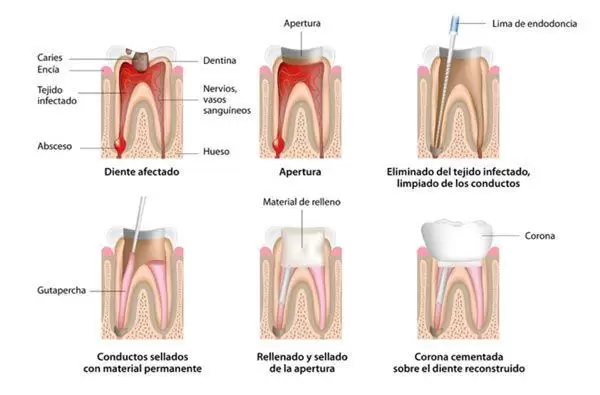 Explicación de la endodoncia paso a paso