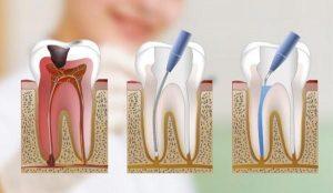 Técnica de Endodoncia
