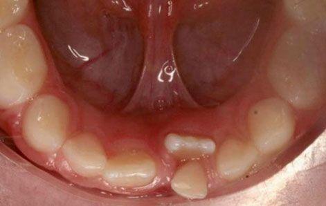 Erupción Dental