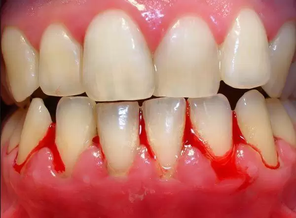 Encías con gingivitis
