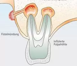 Ilustración de fistula en la encía