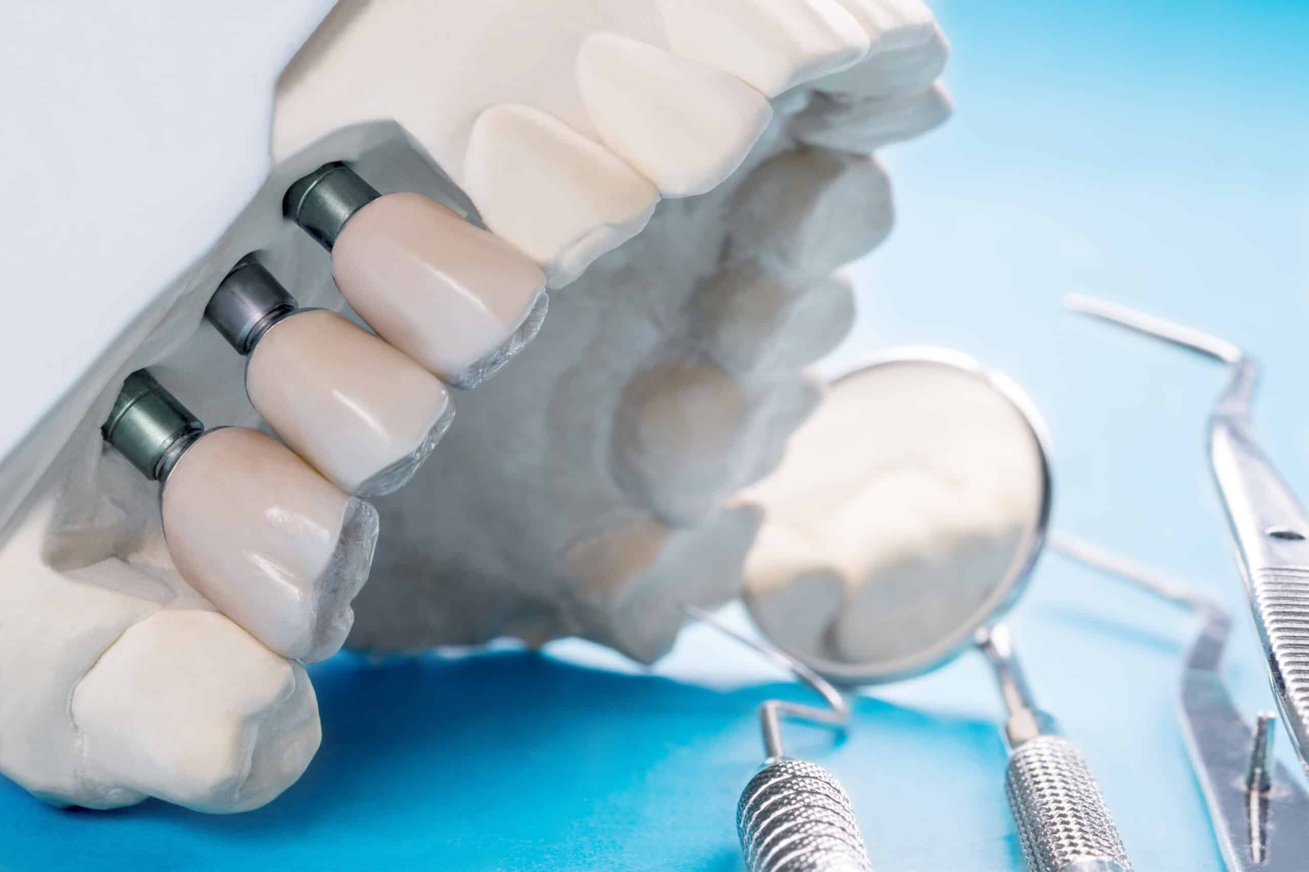 Ilustración de implante dental en un día