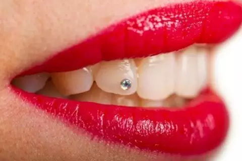 Sonrisa con joyería dental
