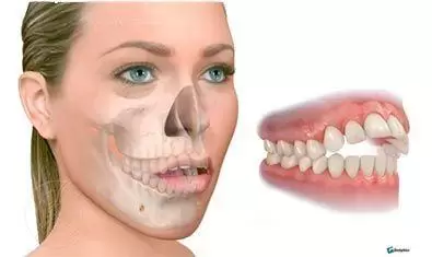 Mujer con mordida abierta
