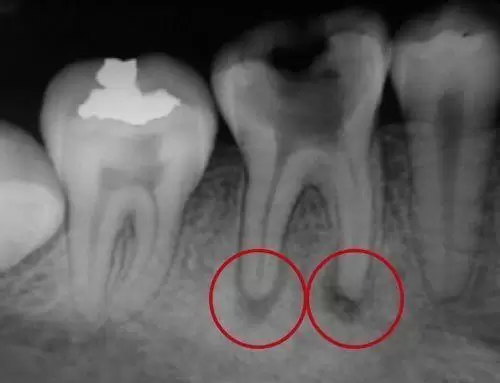 Ecografía de las posibles complicaciones de la endodoncia