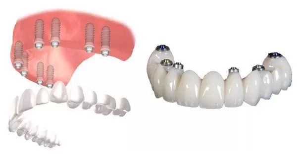 Prótesis Fija sobre implantes de tipo implantosoportada