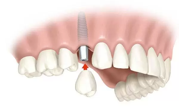 Prótesis Fija sobre implantes de tipo Corona implantosoportada
