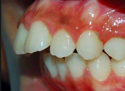 Protusión Dental
