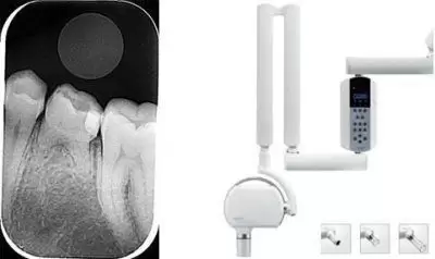 Radiografía periapical