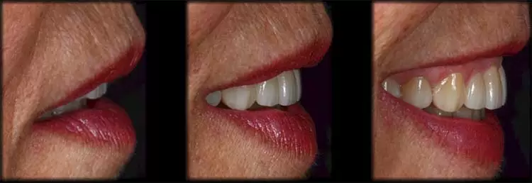 Fotos de caso real de diseño de sonrisa