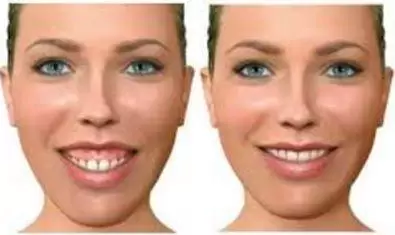 Mujer con sonrisa gingival excesiva