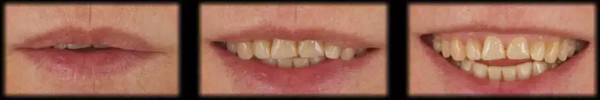 Visualización del resultado de un diseño de sonrisa real