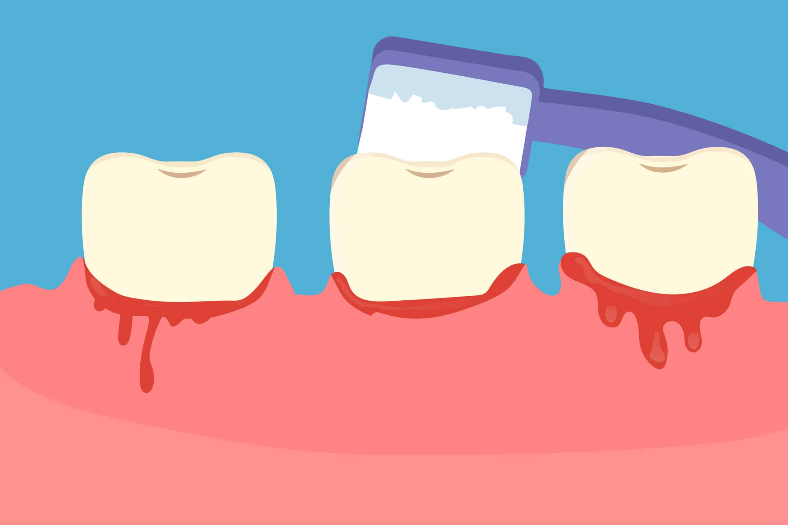 Ilustración de Gingivitis