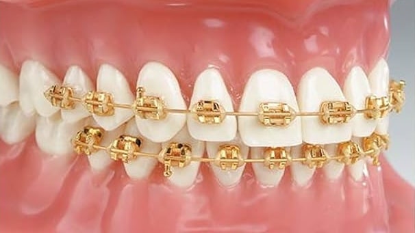 brackets de oro