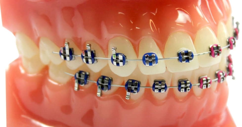 brackets de colores