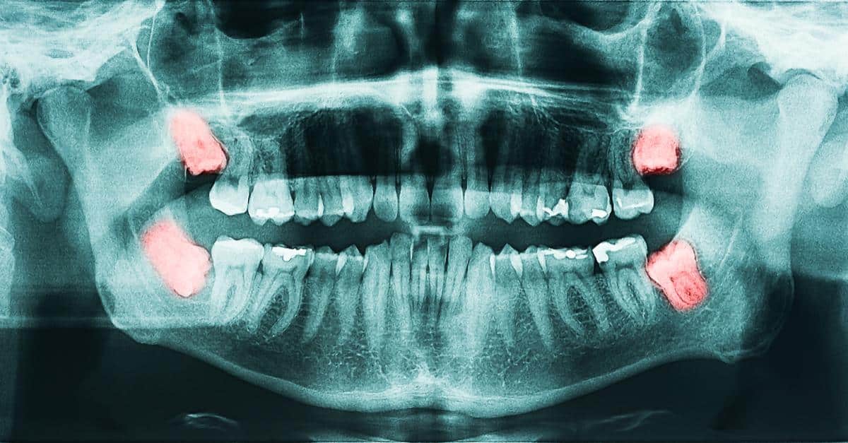 Radiografía de una boca con muelas del juicio en rojo