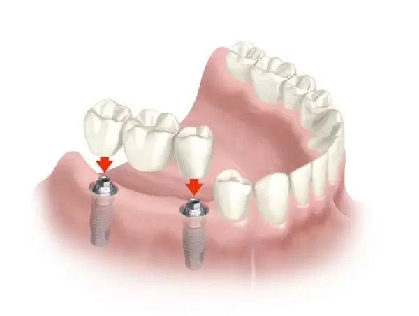 Prótesis Fija sobre implantes de tipo puente implante