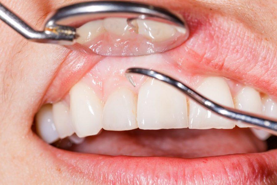 envejecimiento de los dientes