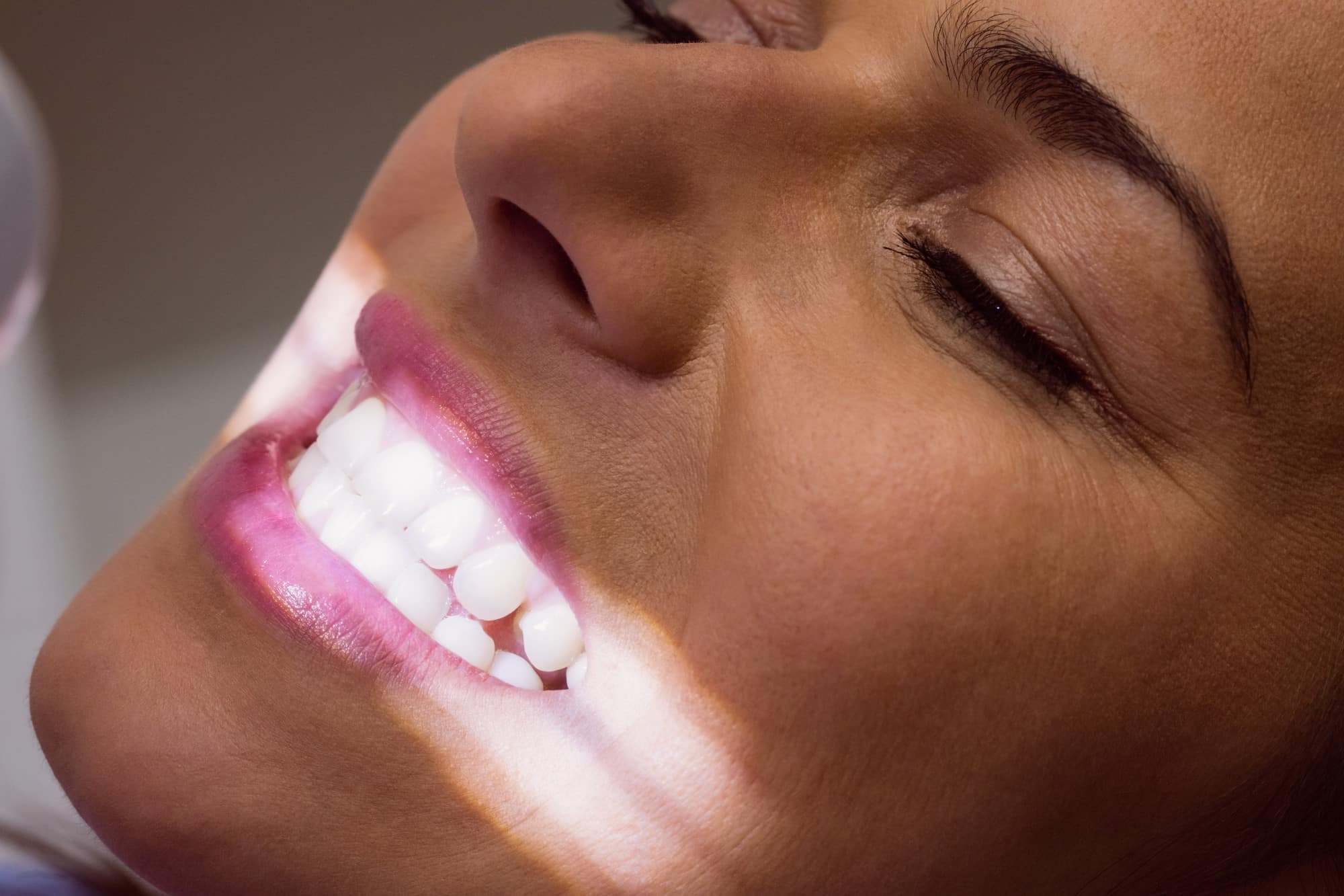 Blanqueamiento dental coste