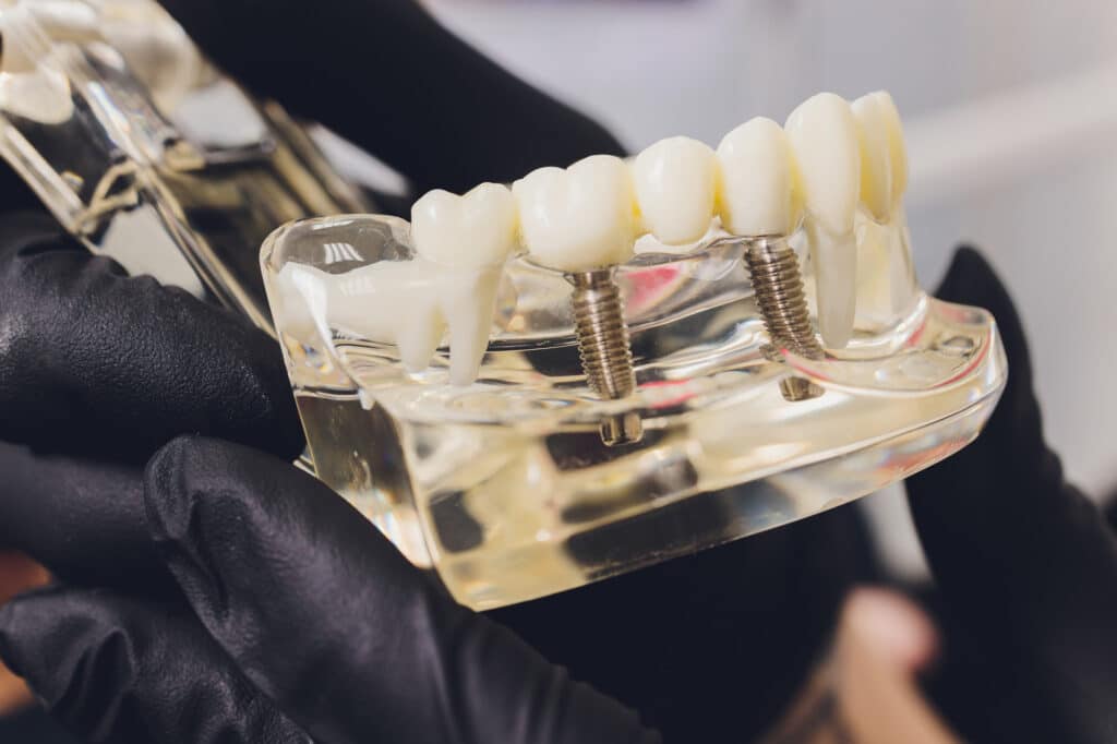 Maqueta de un implante dental