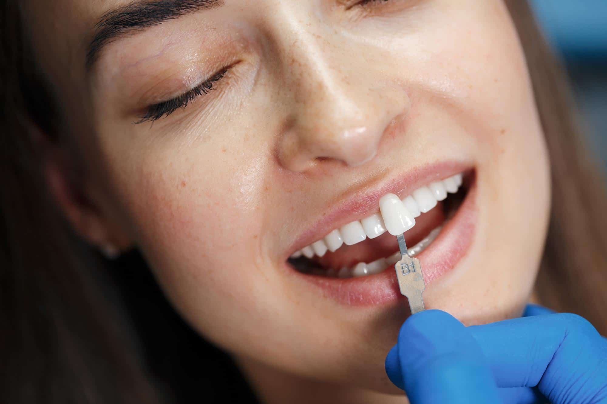 Carilla dental sobre los dientes