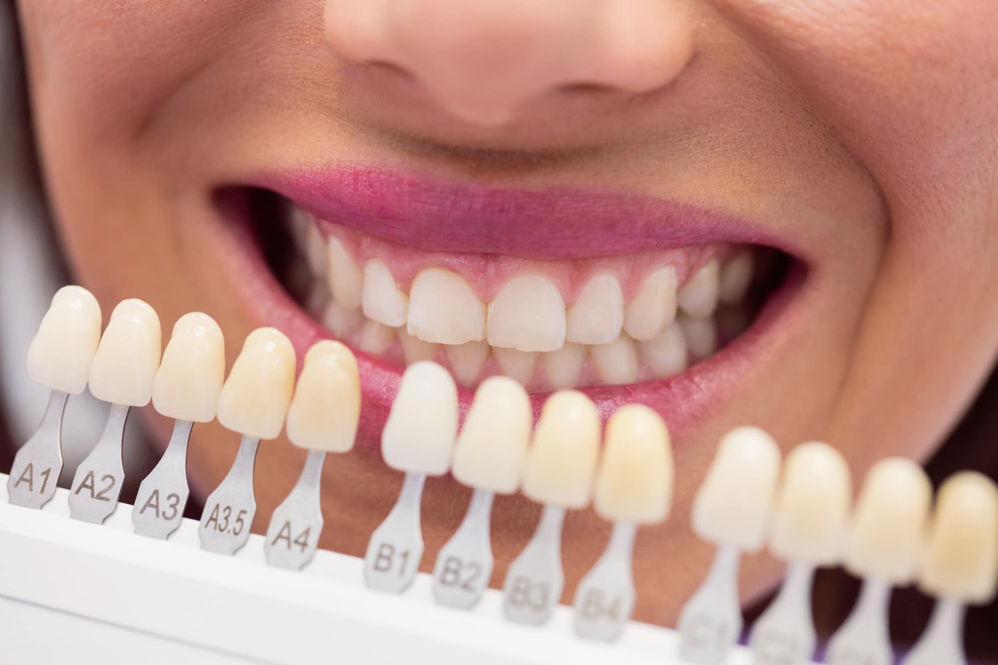 carillas dentales precios