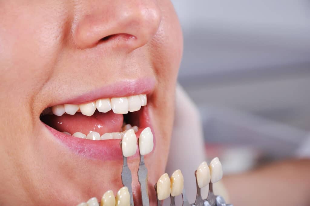 Coste de una carilla dental