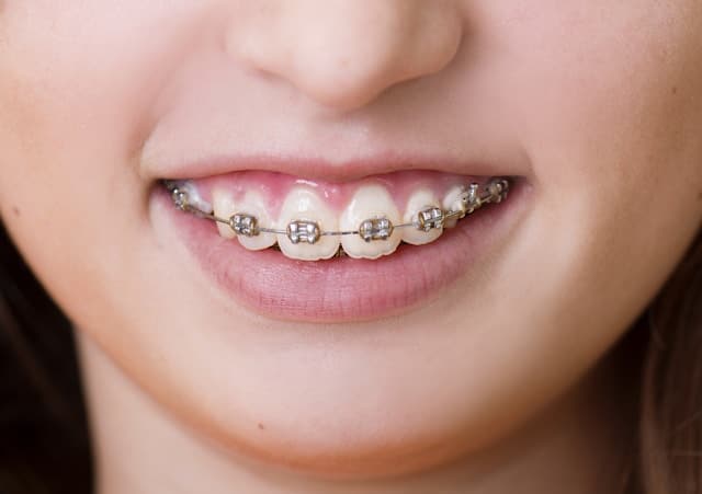 niña con brackets