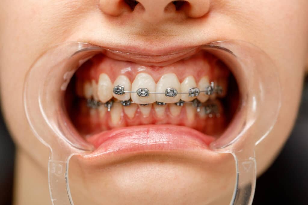 Brackets de cerca